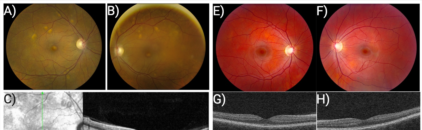 Figure ure 1: Clinical images of patients treated with MEK inhibitors. A-B) Fundus photos from patient who developed MEKAR of the right (A) and left (B) eye showing subretinal fluid accumulation in the fovea and along the arcades. C-D) OCT images from patient who developed MEKAR showing location of subretinal fluid accumulation in the interdigitation zone between the photoreceptor outer segments and the retinal pigment epithelium in the right © and left (D) eye. E-F) Fundus photos from patient who did not develop MEKAR of the right (E) and left (F) eye showing no evidence of subretinal fluid accumulation. G-H) OCT images from patient who did not develop MEKAR of the right (G) and left (H) eyes showing no evidence of subretinal fluid accumulation.