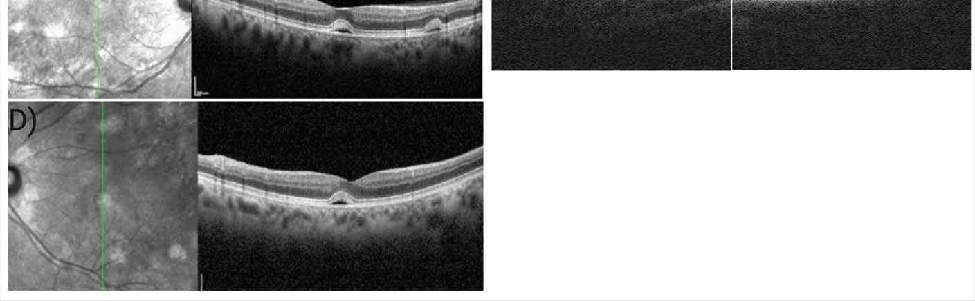 Figure ure 3: Selumetinib increases rod outer segment phagocytosis in hiPSC-derived RPE of an NF1 patient with MEKAR. A) There was no significant difference in total RHO between untreated and treated conditions in either patient. B) There was a significant increase in internalized RHO in treated cells from the NF1 patient with MEKAR. C) Phagocytosis was determined by Western Blot using antibodies targeted against RHO, the rod-specific photopigment that is absent in RPE cells.